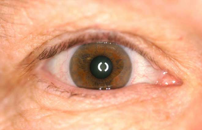 Prosthetic Eyes Patented Digital Technology