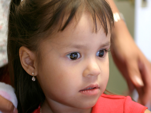 Congenital Anophthalmia