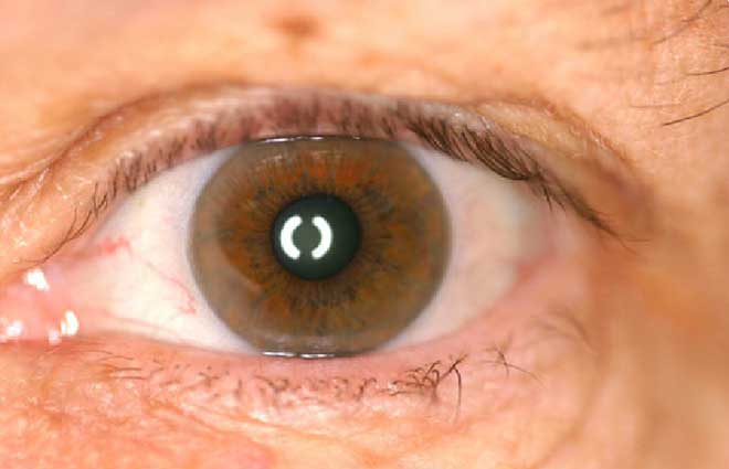 Prosthetic Eye Technology