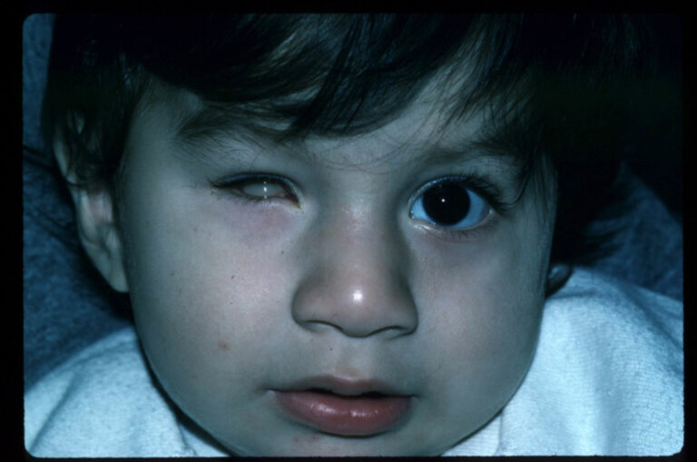 Congenital Anophthalmia & Micropthalmia | Esthetic Eyes