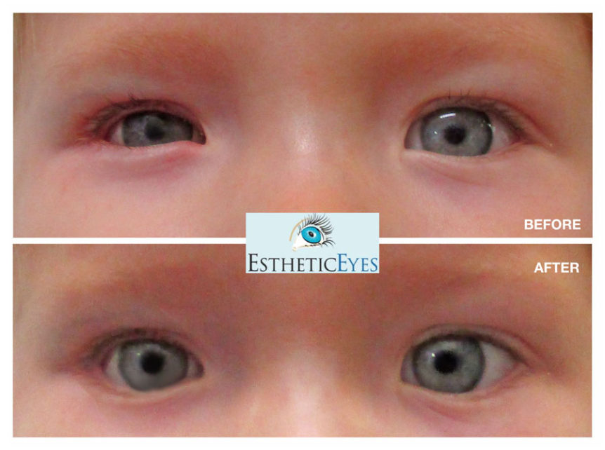 What is Ocular Stenting? | Esthetic Eyes